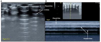 Case Report: Neonatal Massive Pneumothorax Resulting in Compression Atelectasis Treated by Ultrasound-Guided Pleural Puncture Therapy: A Typical Case Based on Lung Ultrasound Finding